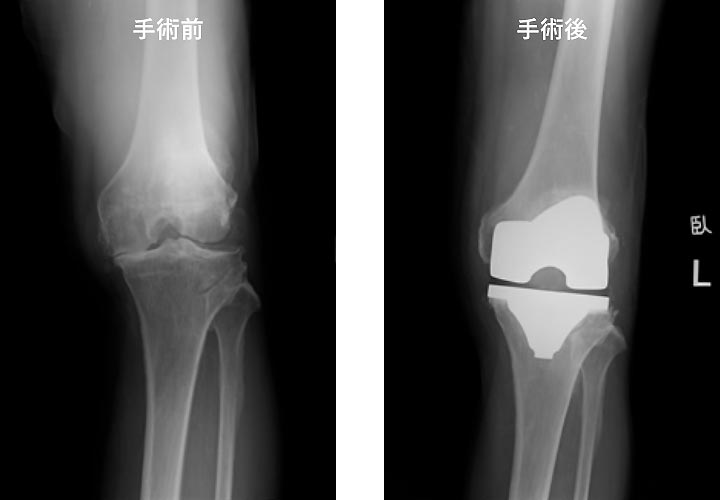 膝関節疾患