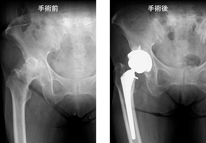 股関節疾患